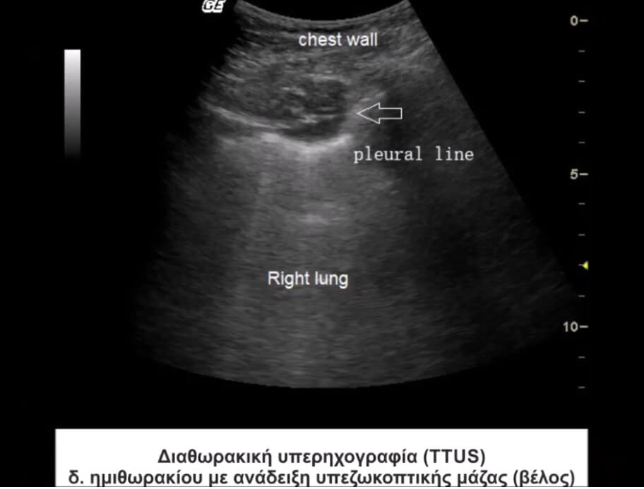 Ultrasound-guided Trans Thoracic Biopsy (usTTB)