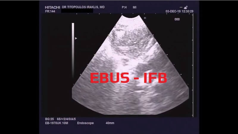 EBUS - IFB